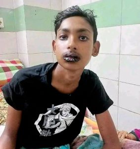 প্যারাসিটামল রি-অ্যাকশন
